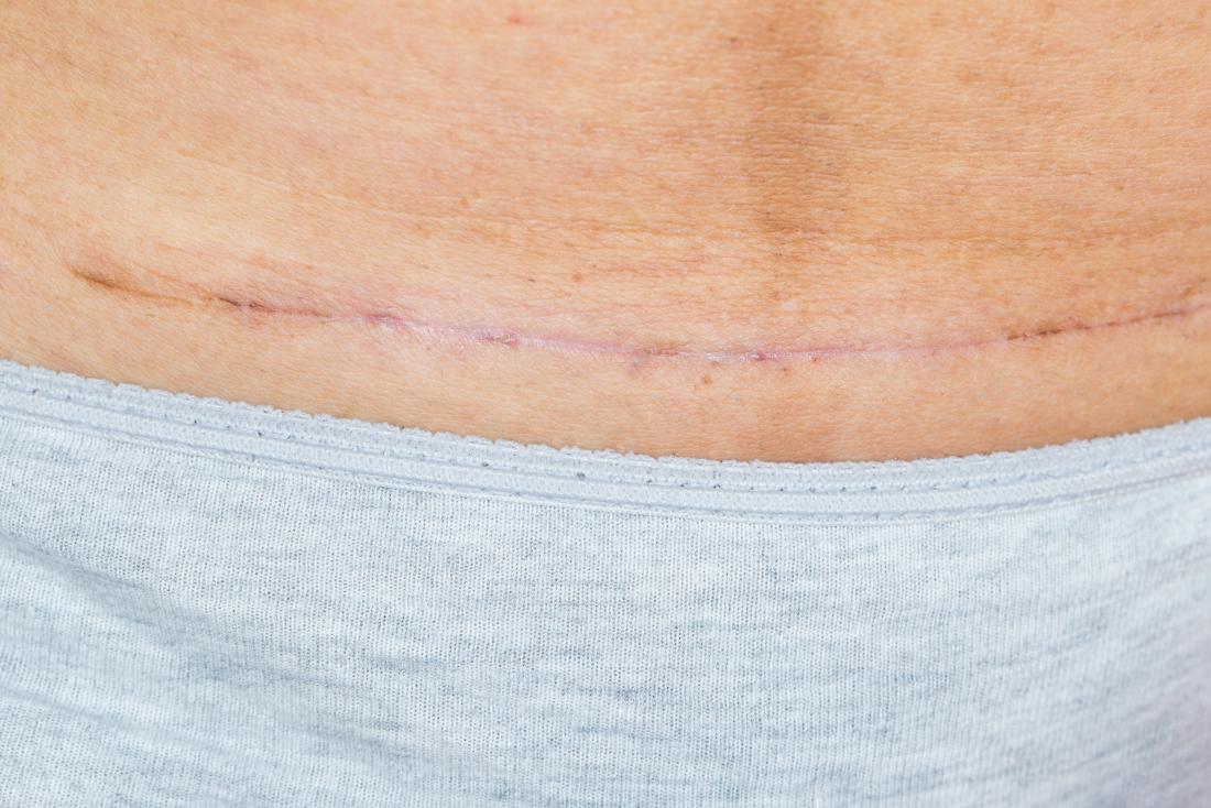 Caesarean scar pictures